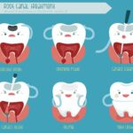 4 Tips For Choosing A Dentist For Root Canal Treatment