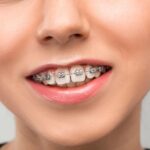 How To Fix An Underbite or Overbite With Braces